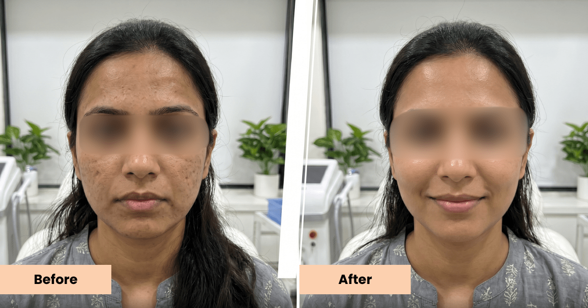 Benefits of GFC Face Treatment Mumbai